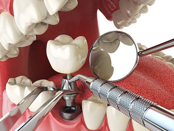 Best Emergency Denture Repair in Payette, ID
